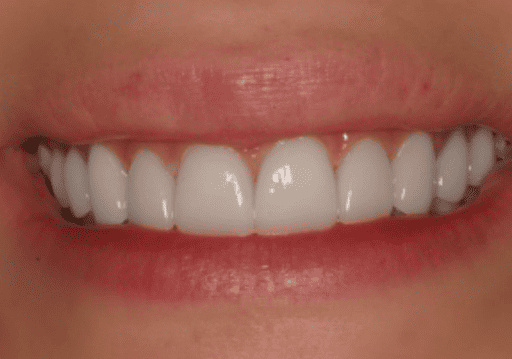 Understanding the Benefits of Dental Veneers