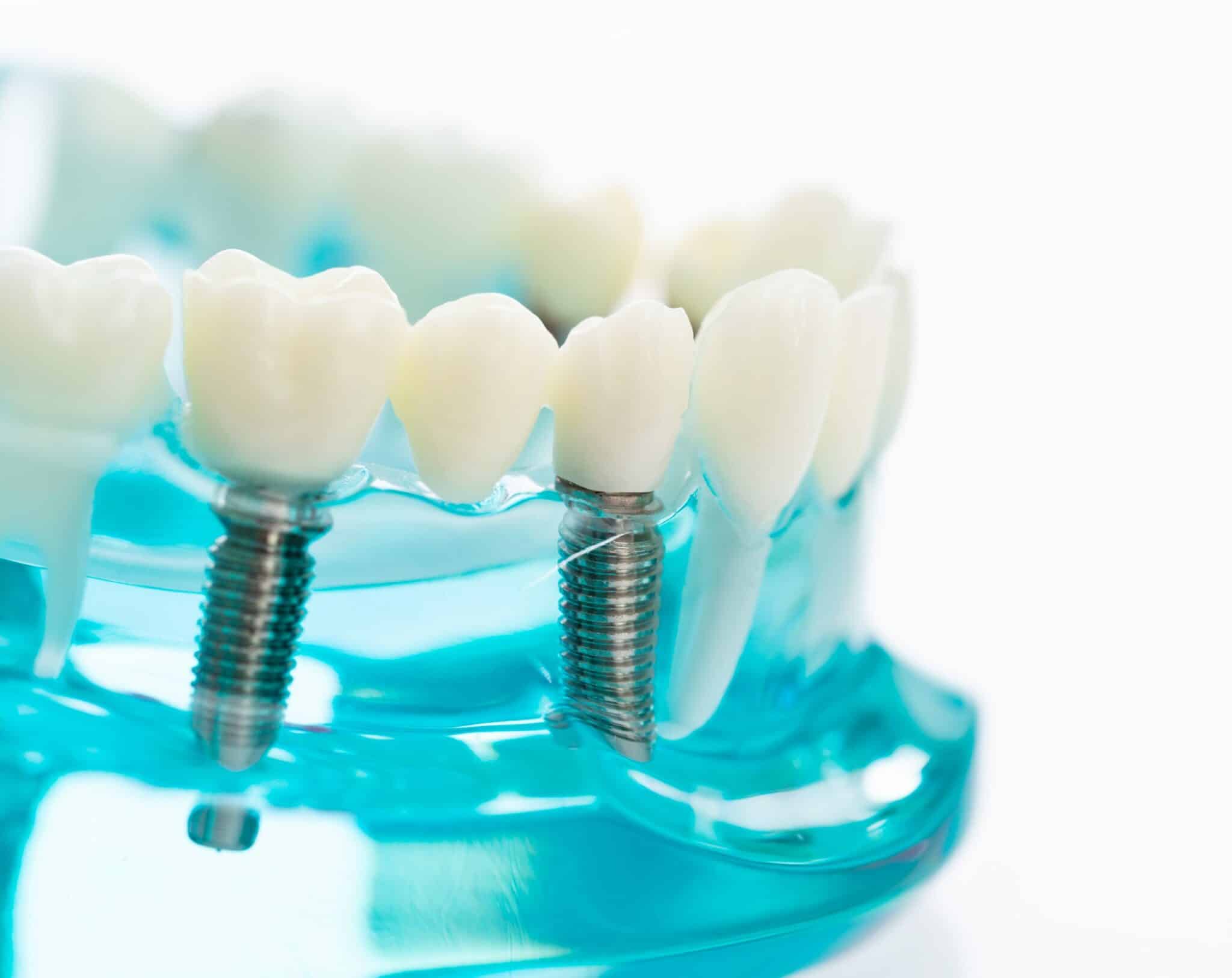 How Dental Implants Can Bring Back Your Smile