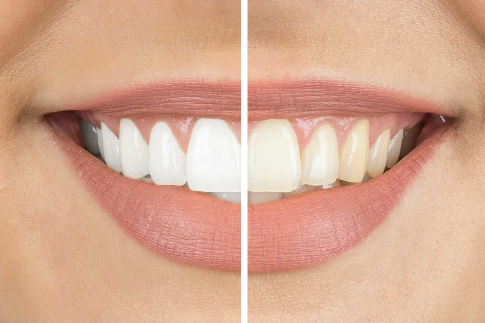 Teeth Whitening: How Do I Get My Teeth White Again?