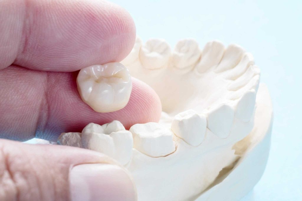 Dental Crowns Questions and Answers