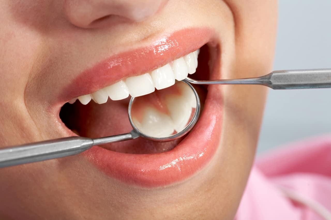 15 Facts About Dental Fillings and Cavities