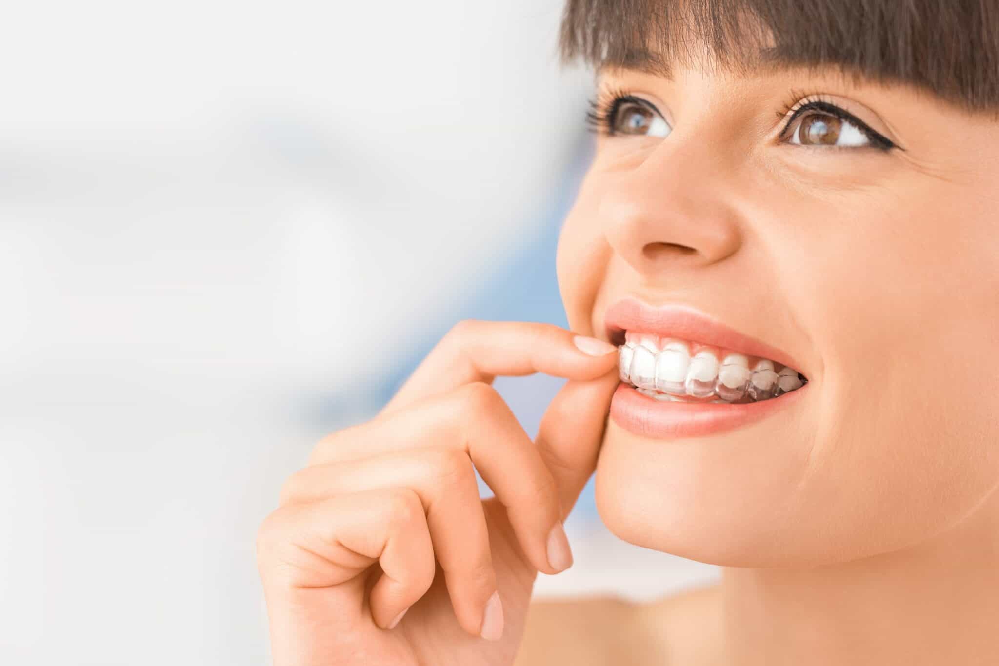 8 Facts About Invisalign Aligners