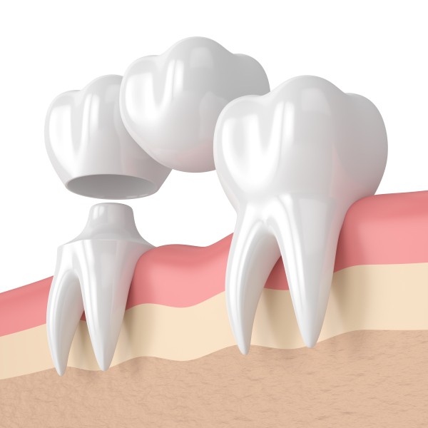 3D illustration of a dental bridge