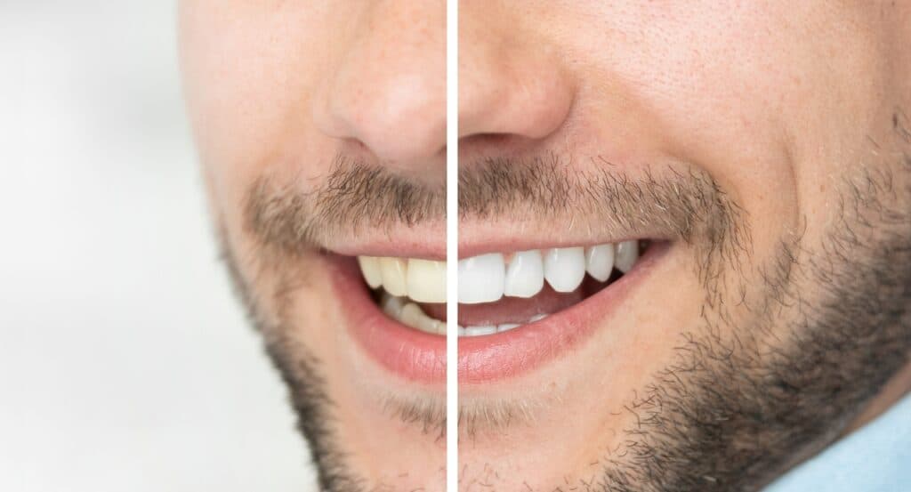 Teeth Whitening: Why It’s Best To Visit a Cosmetic Dentist