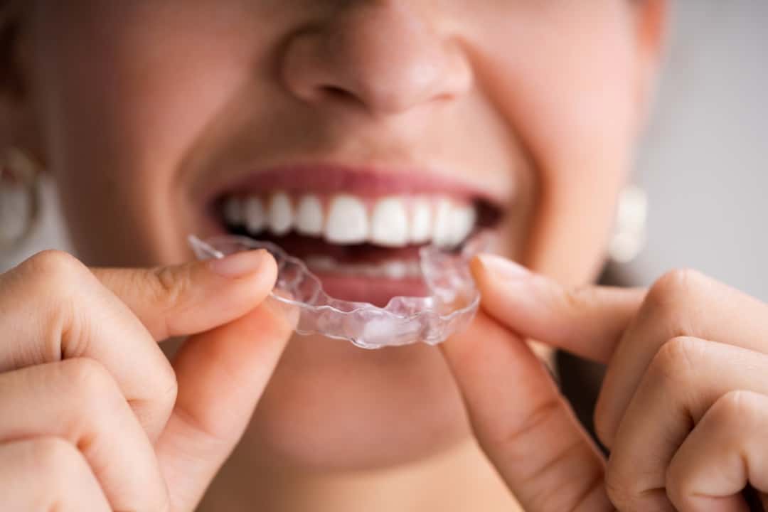 Mouth Guards: How to Guard Against Bruxism