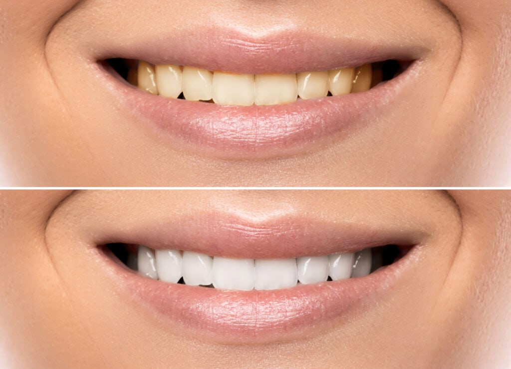 Smile Makeovers: Treatments and How They Work