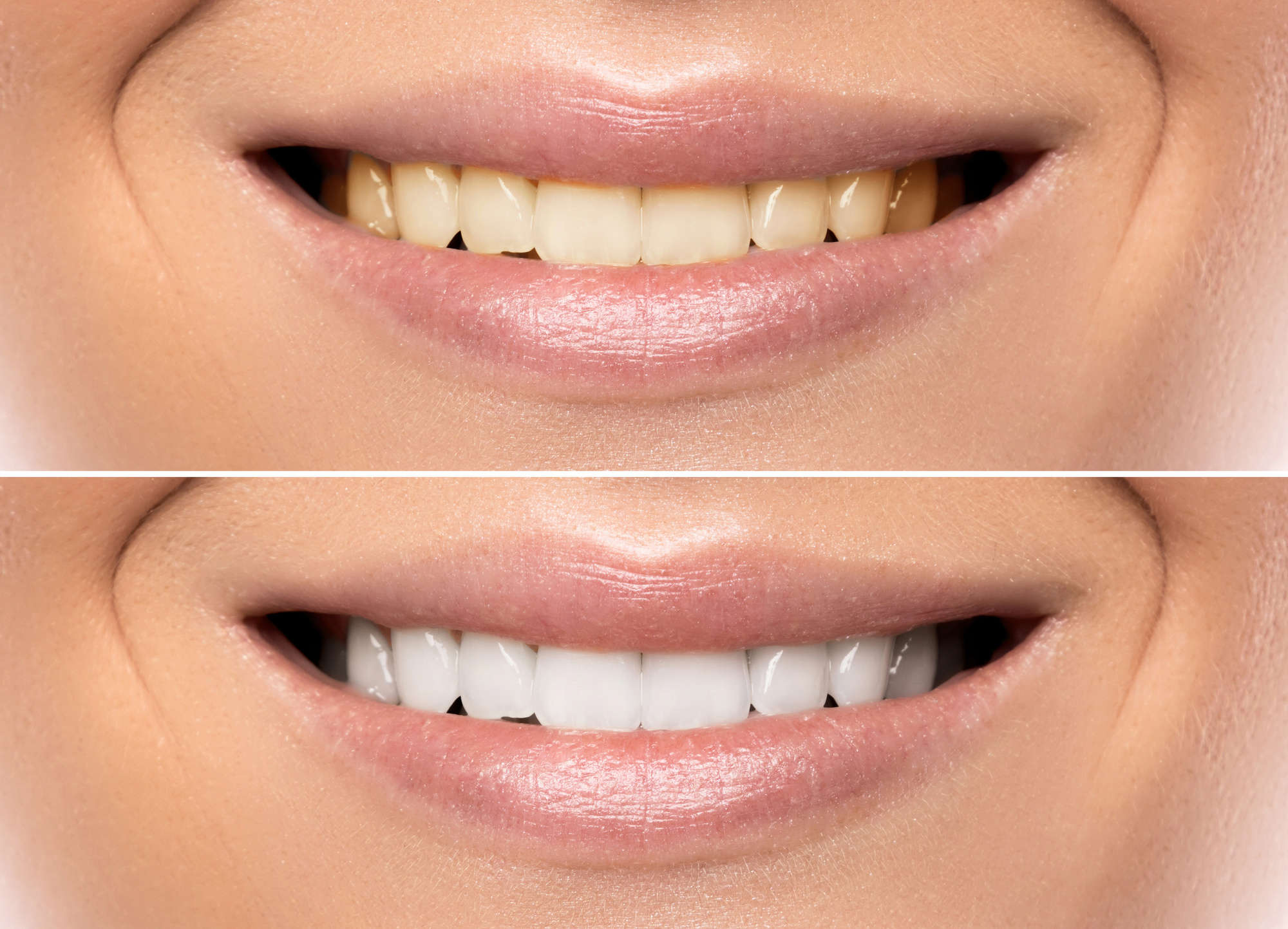 Smile Makeovers: Treatments and How They Work