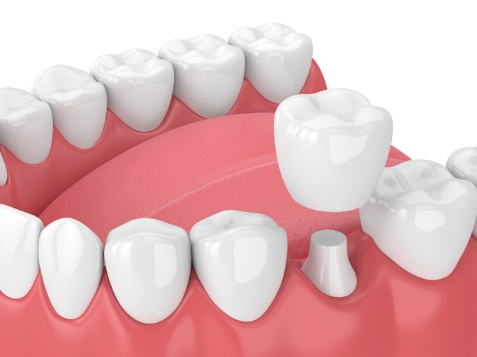 dental crown 3d illustration